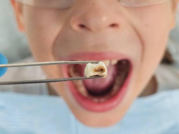 Best Broken or Cracked Tooth Emergency Dentist in Annapolis Neck, MD